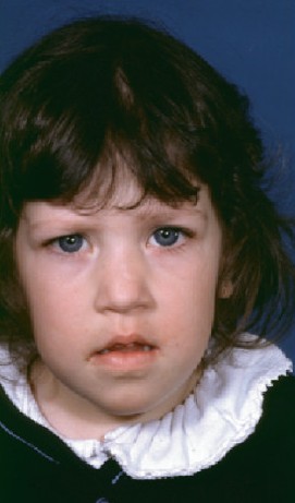 9 year old girl with phenotypic features of de Grouchy syndrome (deletion 18p).jpg
