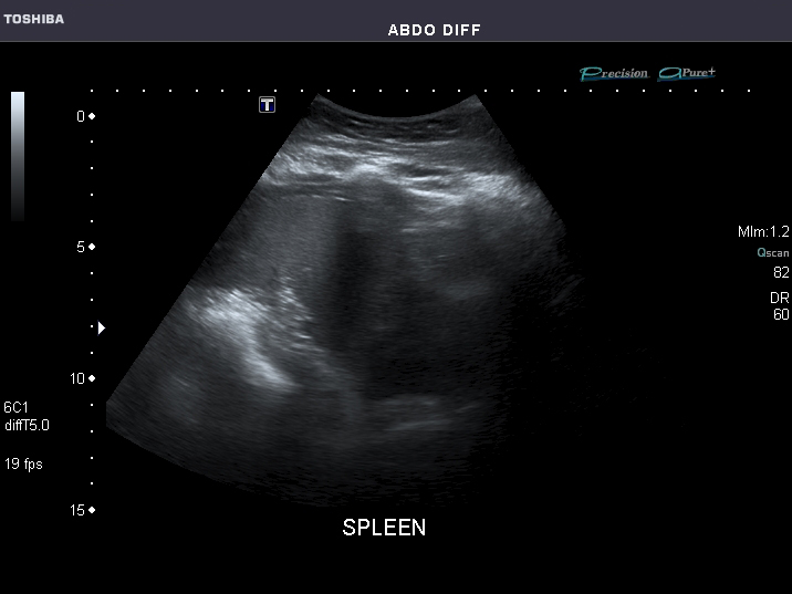 File:Abdominal Ultrasound Full Exam 53.jpg