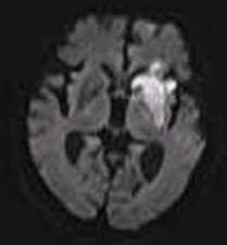 File:Cerebral infarction after 4 hours on DWI MRI.jpg