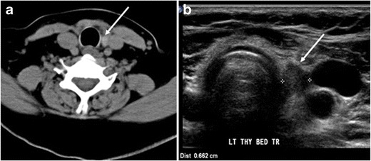 File:CT and ultrasonography of residual normal thyroid tissue after thyroidectomy.jpg