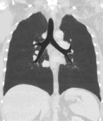 File:Coronal minimum intensity projection CT thorax.gif