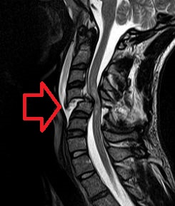Cervical Spine MRI (T2W).jpg
