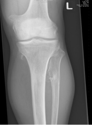 File:Multiple osteochondromas around the knee.jpg