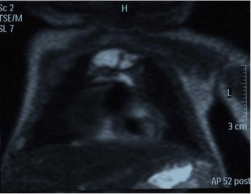 File:Chest MRI showing hemothorax in a 16 day old infant (cropped).png