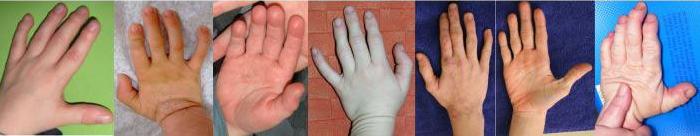 Pictures of the hands of NCBRS