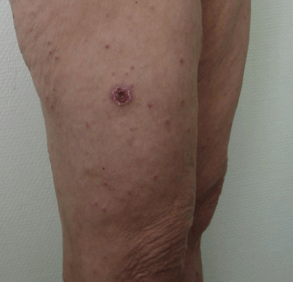 File:Eschar and spots Mediterranean spotted fever.gif