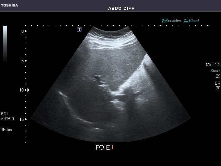 File:Abdominal Ultrasound Full Exam 23.jpg