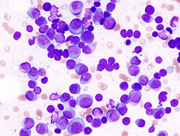 File:Multiple myeloma (1) MG stain.jpg