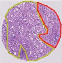 Micrograph of prostate cancer with Gleason pattern 9 (4+5).jpg