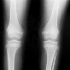 X-ray of the knees of a 9-year old boy with Hall-Riggs syndrome.png