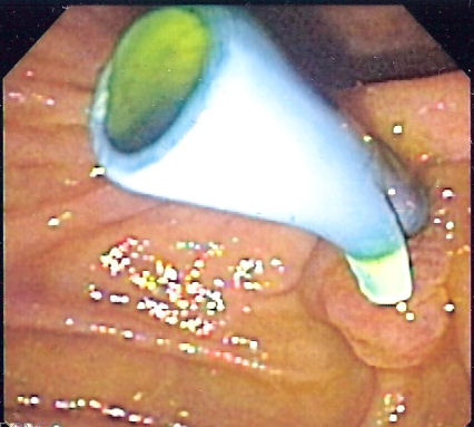 File:Biliary stent endo.jpg