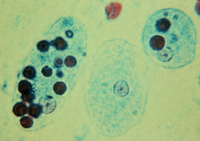 File:Trophozoites of Entamoeba histolytica with ingested erythrocytes.JPG