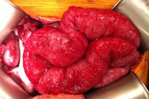 File:Intestines with peritoneal carcinomatosis from gastric cancer.jpg