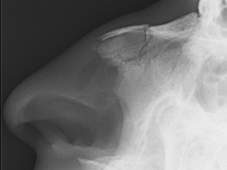 File:Medical X-Ray imaging NJR06 Nevit nasal bone fracture.jpg