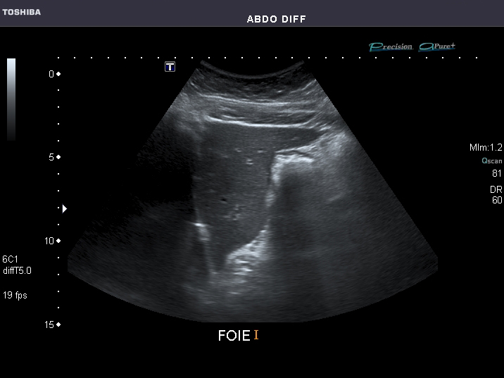 File:Abdominal Ultrasound Full Exam 48.jpg