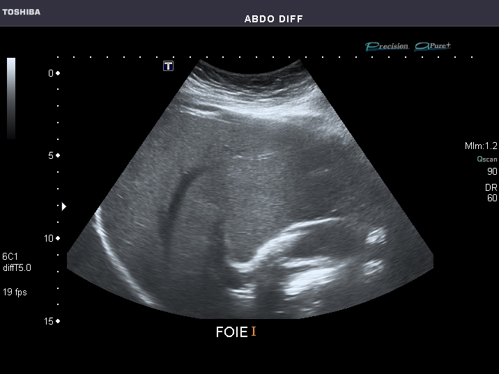 File:Abdominal Ultrasound Full Exam 24.jpg