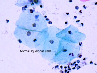 File:Squamous cells.jpg