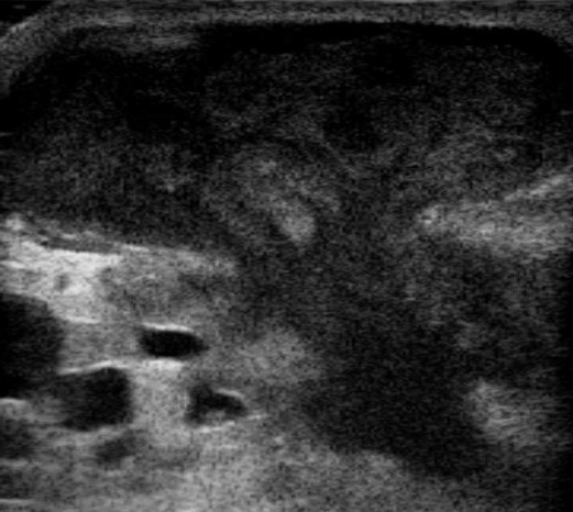File:Ultrasound image of breast 110323101432 1023060.jpg