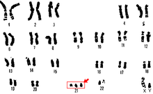 Trisomy 21 chromosome