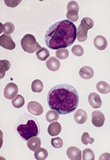 File:Two myeloblasts with Auer rods.jpg