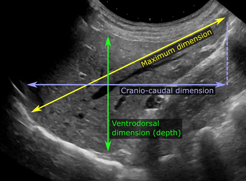 File:Liver measurements on ultrasonography.jpg