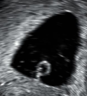 Anembryonic gestation.jpg