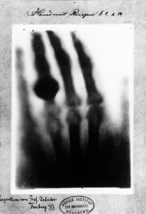 File:First medical X-ray by Wilhelm Röntgen of his wife Anna Bertha Ludwig's hand - 18951222.gif