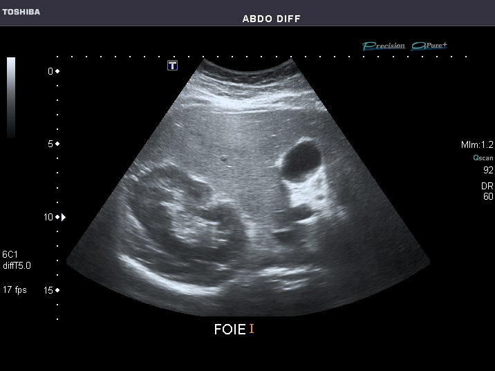 File:Abdominal Ultrasound Full Exam 06.jpg
