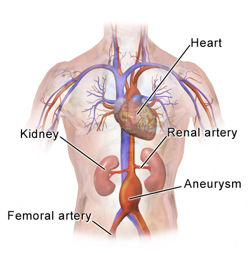 File:Abdominal Aortic Aneurysm Location.png
