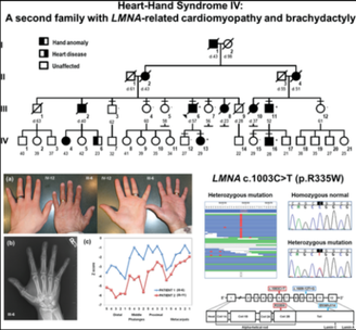 Heart-hand syndrome, Slovenian type.png