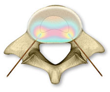 Biacuplasty Isotherm.jpg