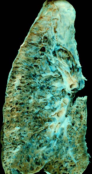 File:End-stage interstitial lung disease (honeycomb lung).jpg
