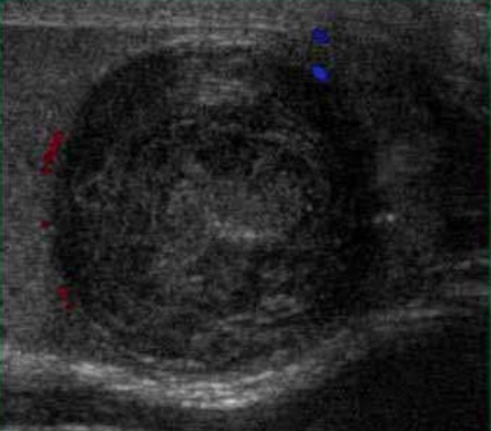 File:Scrotal ultrasonography of epidermoid cyst.jpg