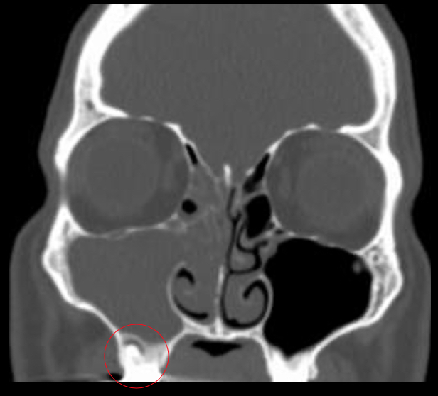 File:Odontogenic sinusitis.jpg
