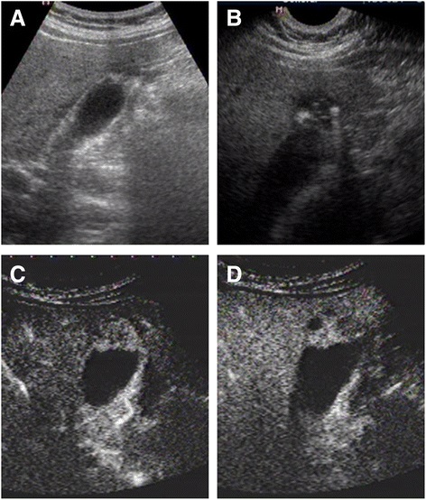 Medicine:Adenomyomatosis - HandWiki