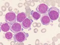 File:Celulas de Leucemia.jpg