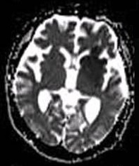 File:Cerebral infarction after 4 hours on ADC MRI.jpg