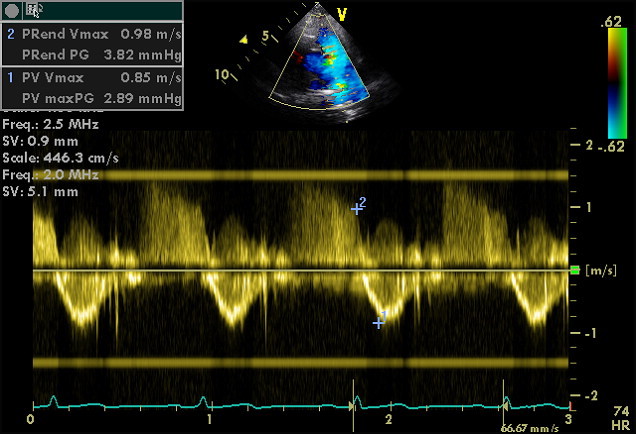 File:Flow in pulmonic valve.jpg