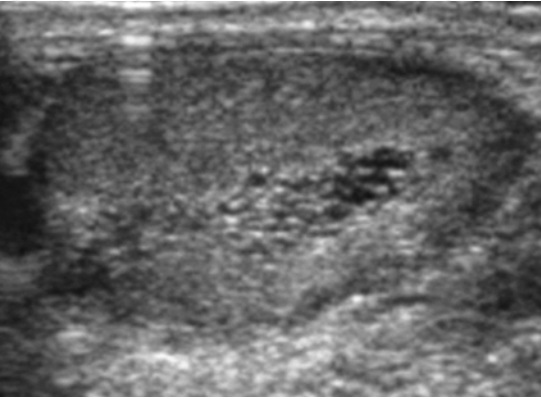 File:Scrotal ultrasonography of tubular ectasia.jpg
