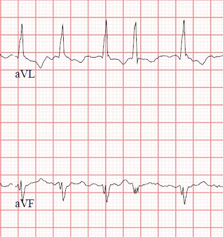 File:Atrial Fibrillation in two leads.jpg