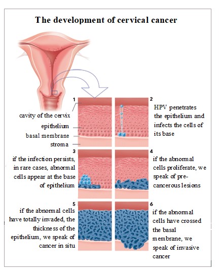File:The development of cervical cancer.jpg