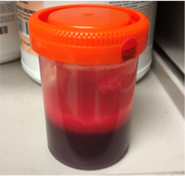 File:Pleural fluid sample from a hemothorax.png