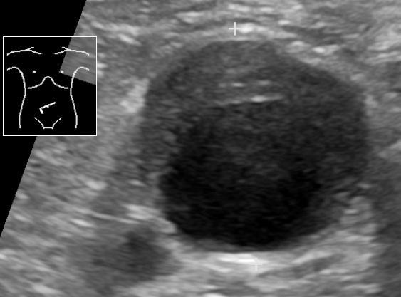 File:Ultrasonography of abdominal aortic aneurysm with mural thrombus.jpg