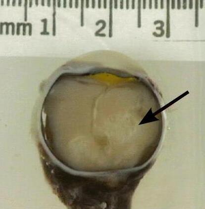 File:Retinoblastoma in enucleated eyeball.jpg