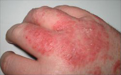 File:Dermatitis.jpg