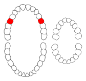 Maxillary second premolars01-01-06.png