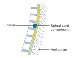 Diagram showing a tumour causing spinal cord compression CRUK 081.svg