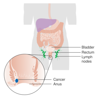 Diagram showing stage 1 anal cancer CRUK 189.svg
