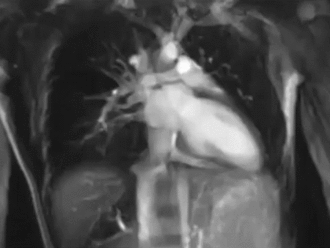Heart MRI.gif