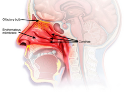 Rhinitis medicamentosa mucosa nasal en.png